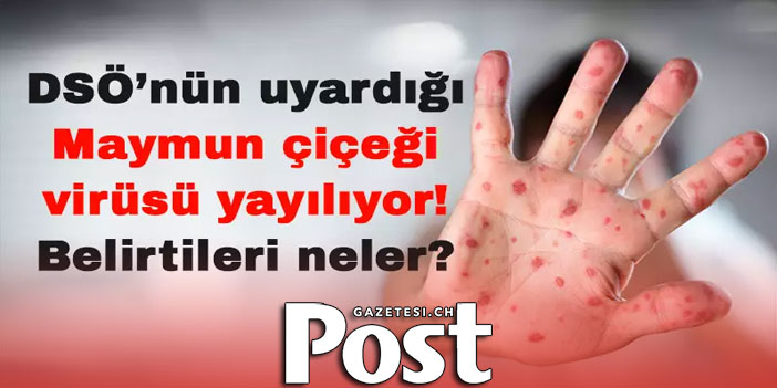 Maymun Çiçeği nedir? Maymun Çiceği belirtileri neler!