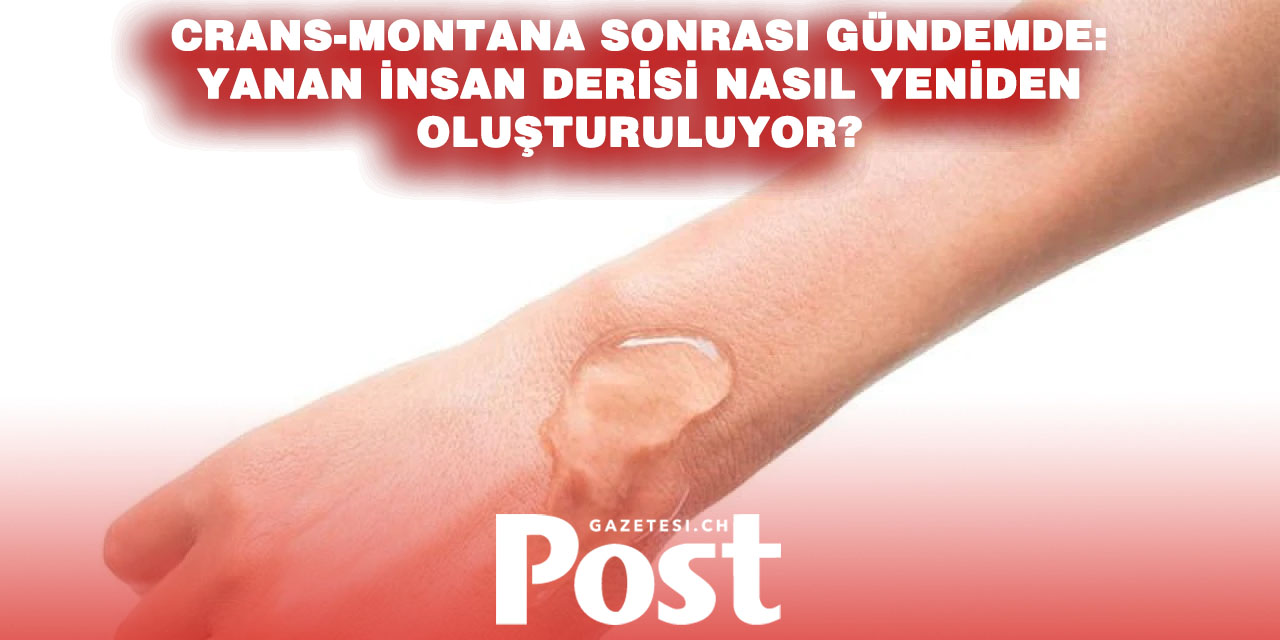 Crans-Montana Faciası Sonrası Merak Edilen Soru: Ağır Yanıklarda İnsan Derisi Nasıl Yenileniyor?