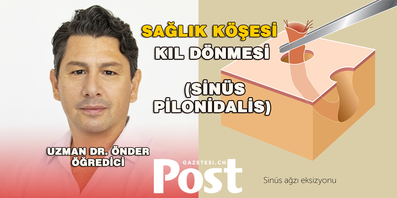 Kıl Dönmesi (Sinüs Pilonidalis)