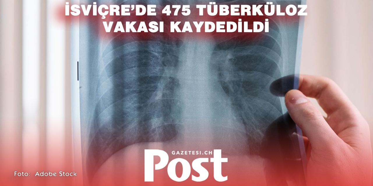 İsviçre’de Tüberküloz Vakaları Yüzde 26 Arttı